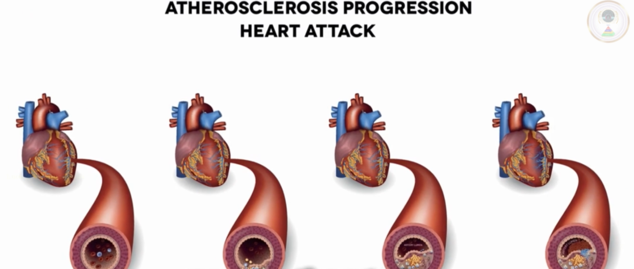 Cardiovascular Disease